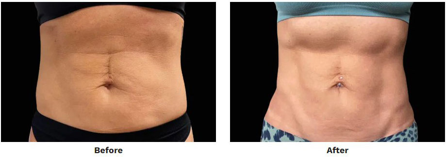 Before and After EMSculpt and EMTone Abdomen Treatment