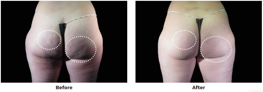Before and After EMSculpt and EMTone Buttock