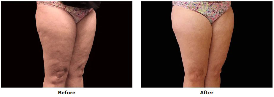 Before and After EMSculpt and EMTone Thighs Treatment