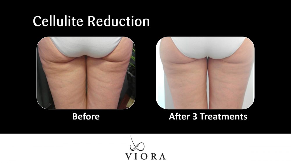 Before and After Viora Cellulite Reduction