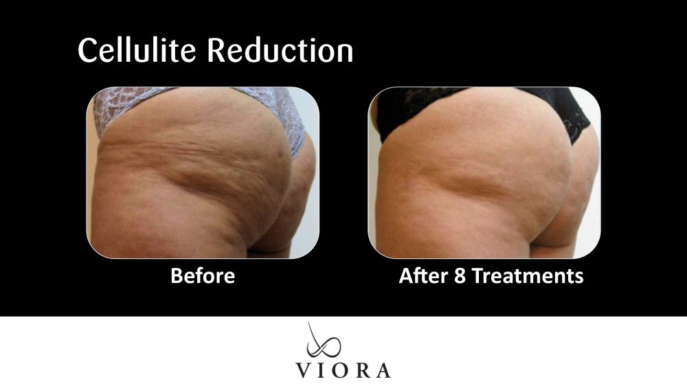 Before and After Viora Cellulite Reduction