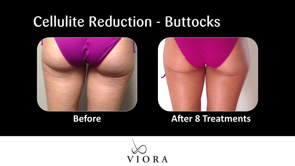 Before and After Viora Cellulite Reduction Buttocks