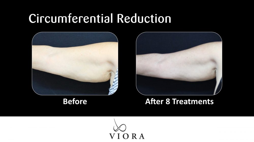 Before and After Viora Circumferential Reduction