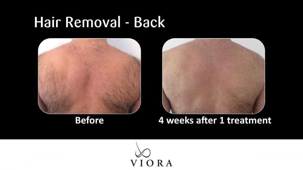 Before and After Viora Hair Removal Back