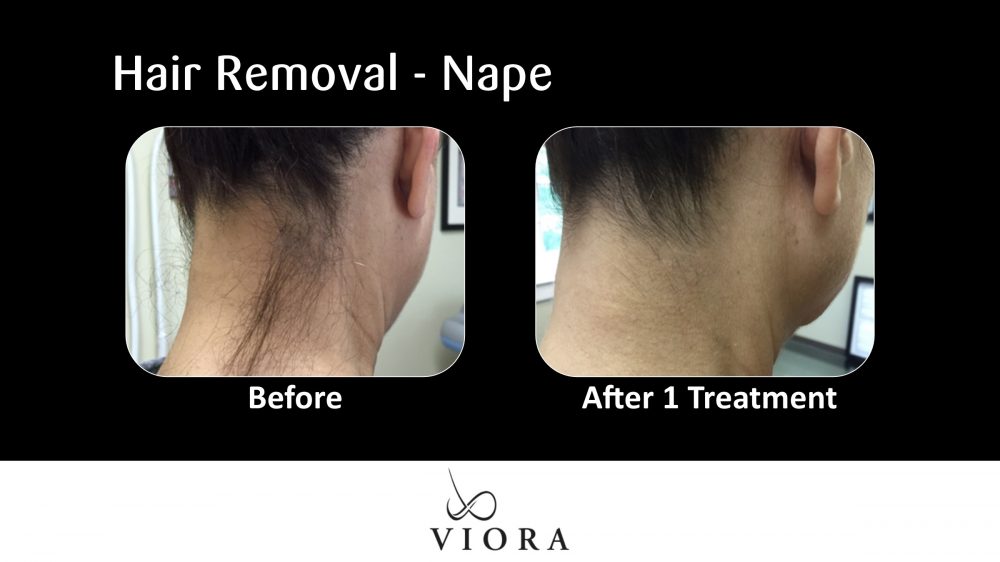 Before and After Viora Hair Removal Nape