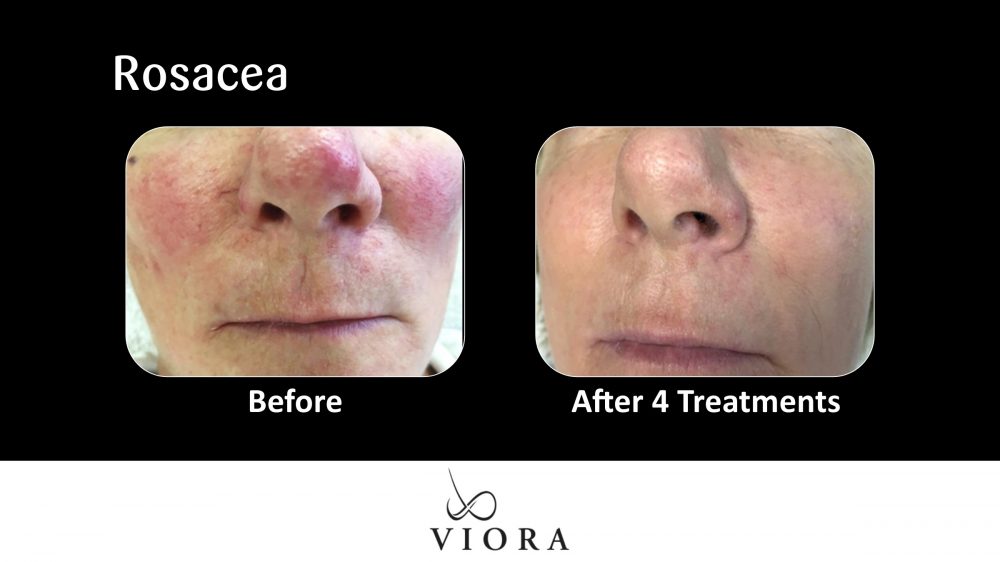 Before and After Viora Rosacea Treatment