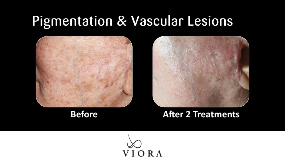 Before and After Viora Rosacea Treatment Pigmentation and Vascular Lesions