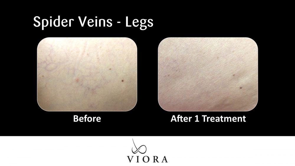 Before and After Viora Rosacea Treatment Spider Veins Legs