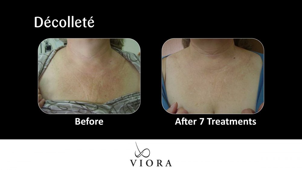 Before and After Viora Skin Tightening Décolleté