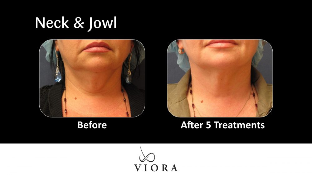 Before and After Viora Skin Tightening Neck and Jowl