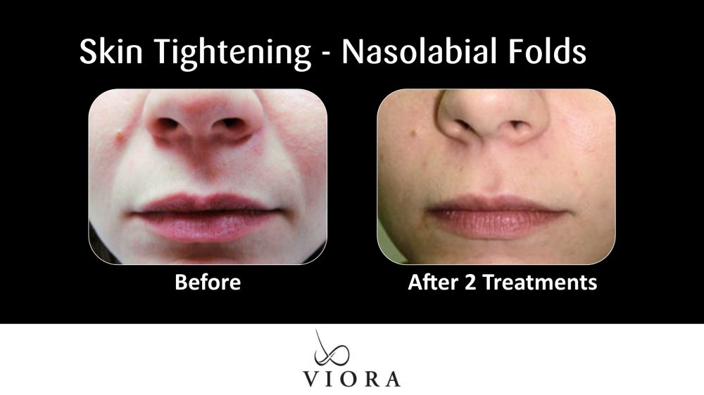 Before and After Viora Skin Tightening Nasolabial Folds