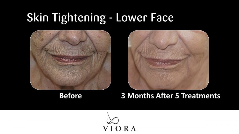 Before and After Viora Skin Tightening Lower Face
